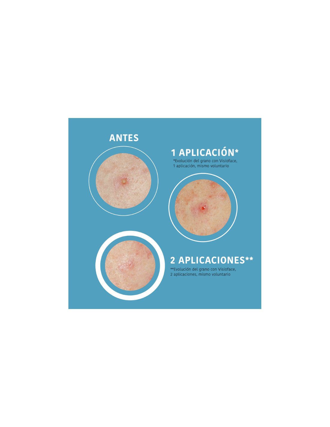 IROHA PARCHES SOS GRANOS CON ÁCIDO SALICÍLICO...