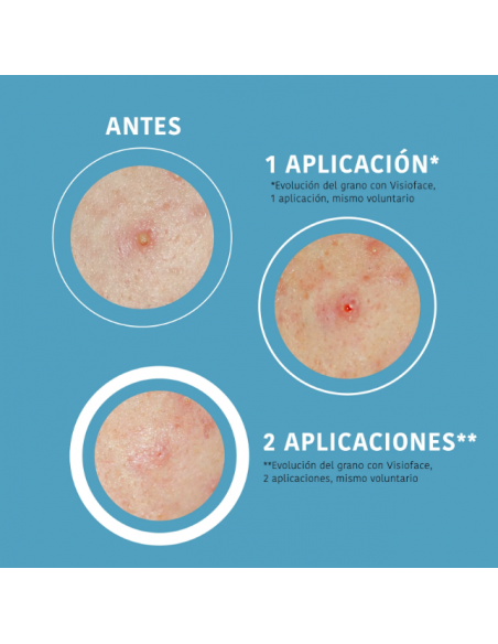 IROHA PARCHES SOS GRANOS CON ÁCIDO SALICÍLICO 18 unidades
