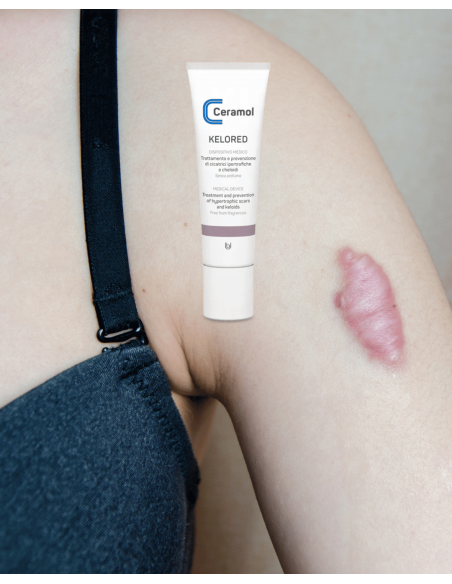 CERAMOL KELORED 30ml (cicatrices hipertróficas y queloides)