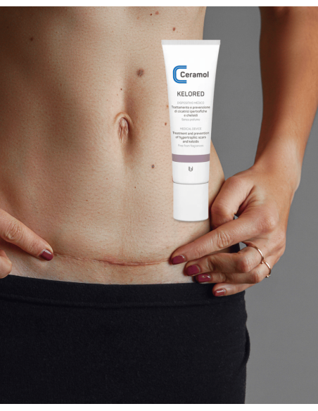CERAMOL KELORED 30ml (cicatrices hipertróficas y queloides)